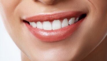 Tooth-Coloured Dental Fillings